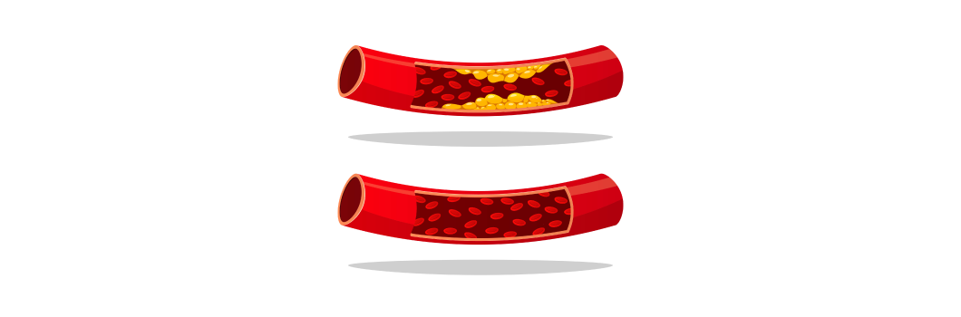 hipercholesterolemia u dzieci