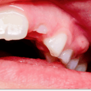 ropień zęba domowe sposoby