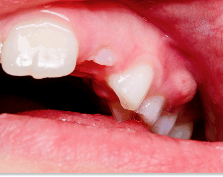 ropień zęba domowe sposoby