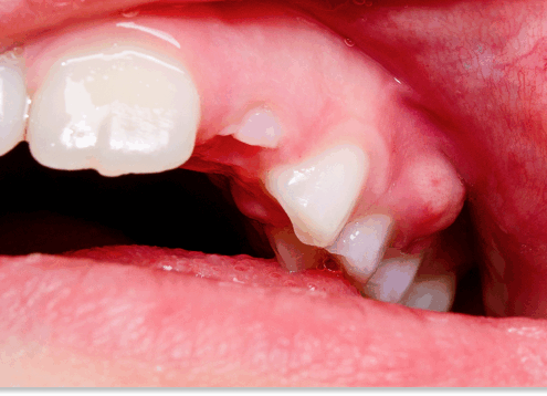 ropień zęba domowe sposoby