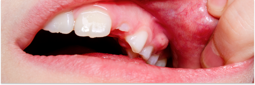 ropień zęba domowe sposoby