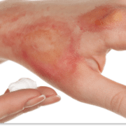 oparzenia pierwsza pomoc