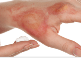 oparzenia pierwsza pomoc