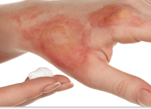 oparzenia pierwsza pomoc