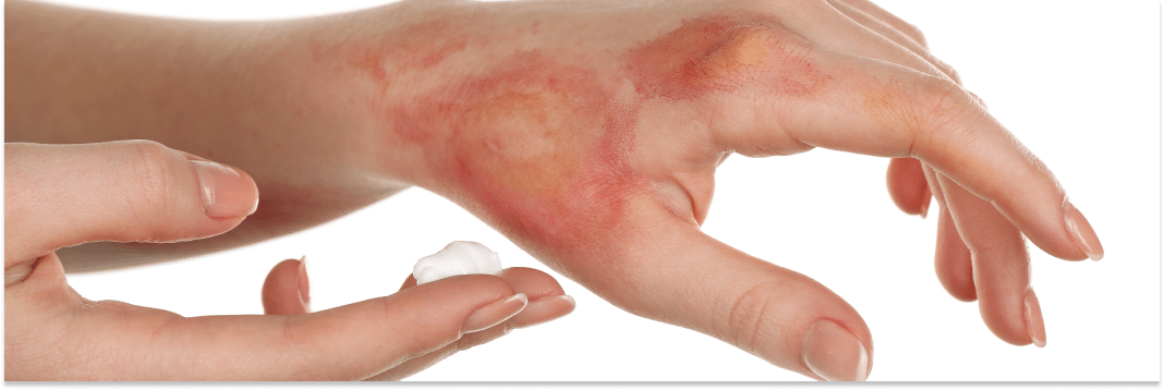 oparzenia pierwsza pomoc