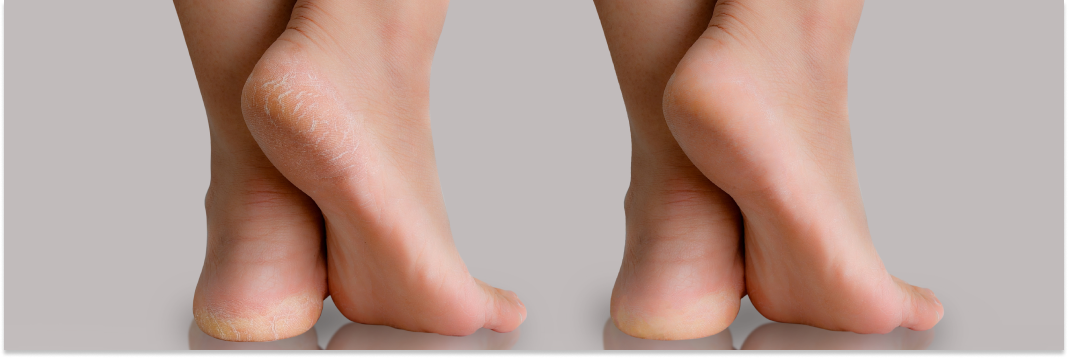 pękające pięty podolog