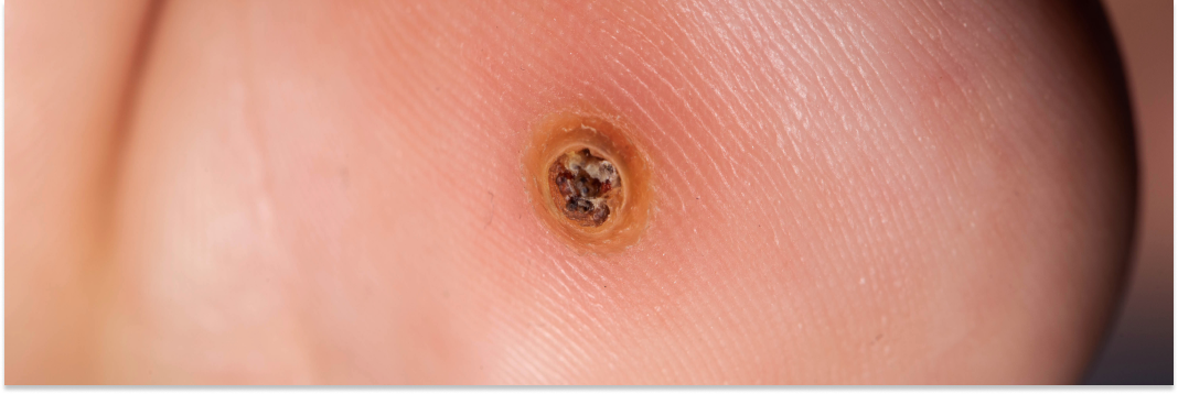 podolog usuwanie kurzajek