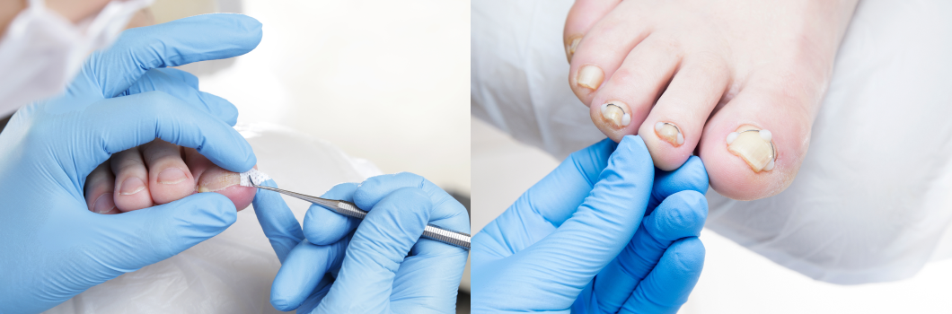 podolog wrastające paznokcie